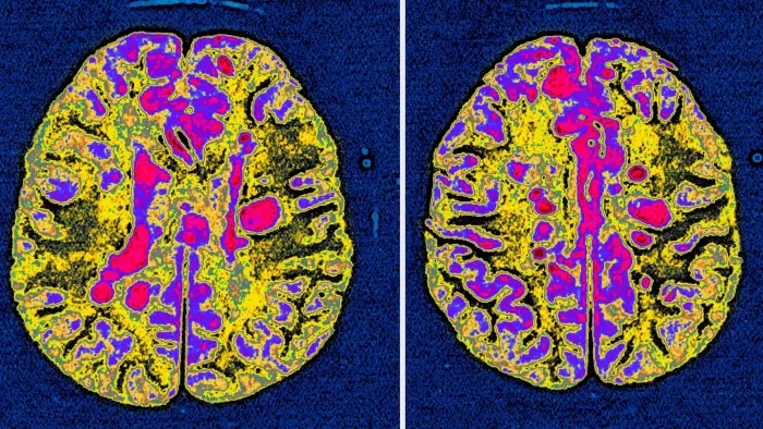 Study raises hopes for drug to reverse the course of MS